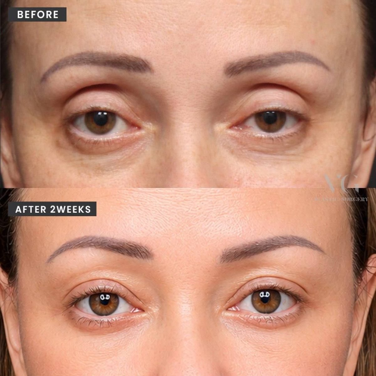 Результаты до и после операции на двойное веко в VG Plastic Surgery, 2 недели спустя