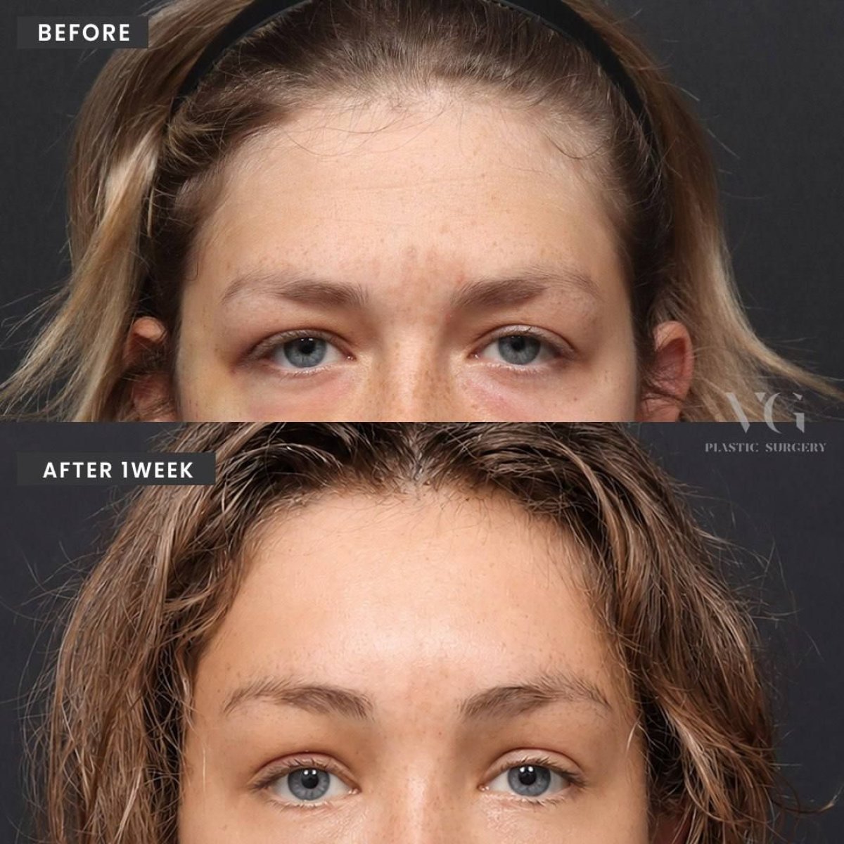 Résultats avant et après chirurgie des paupières tombantes chez VG Plastic Surgery, amélioration