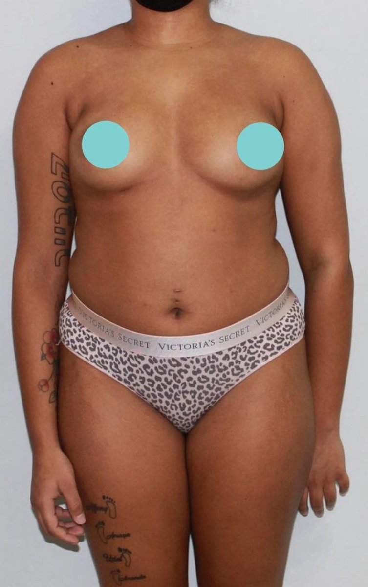 Antes de abdominoplastia y liposucción, abdomen y cintura para planificación del procedimiento