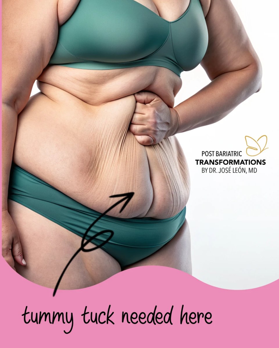 Abdomen antes de abdominoplastia en clínica Dr. José León, exceso de piel visible