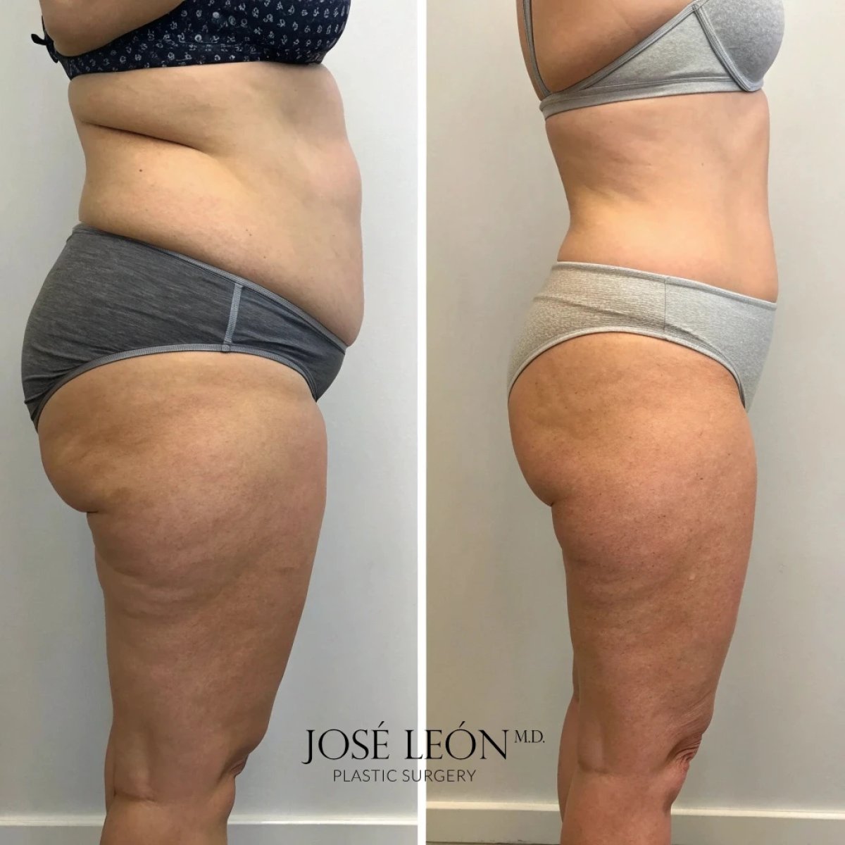 Vorher-nachher-Ergebnis Liposuktion 3 Zonen in José León Klinik, sichtbare Kontur