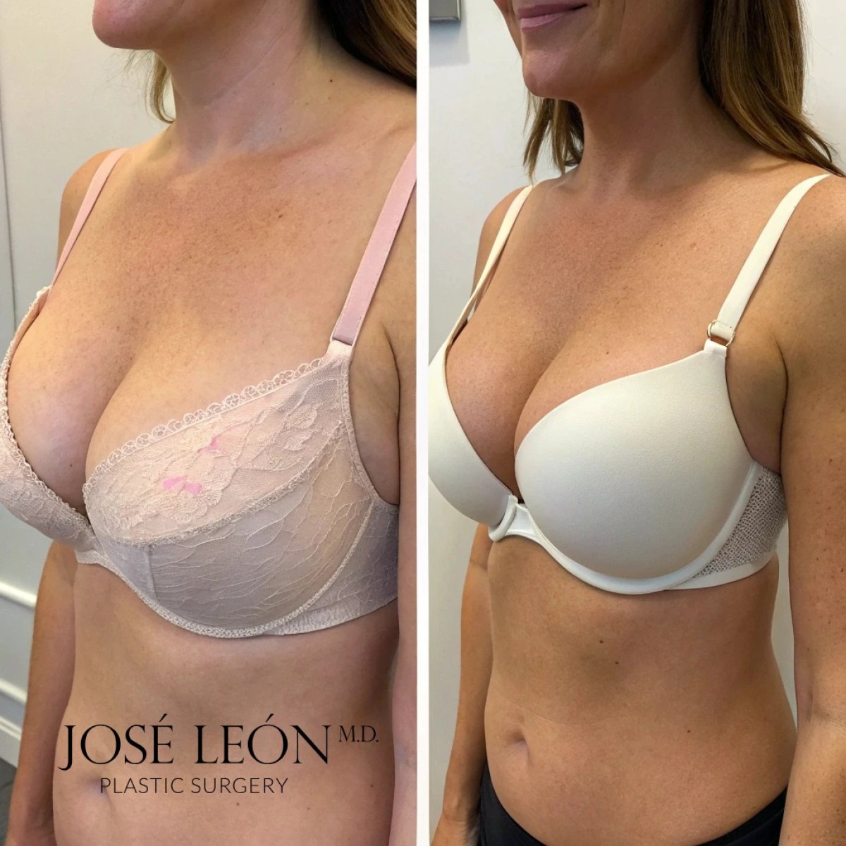 Before and after breast augmentation results at José León Plastic Surgery clinic