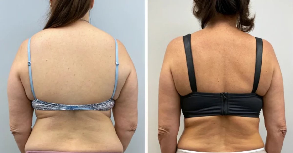 Before and after liposuction results – improved back contour and reduced fat deposits