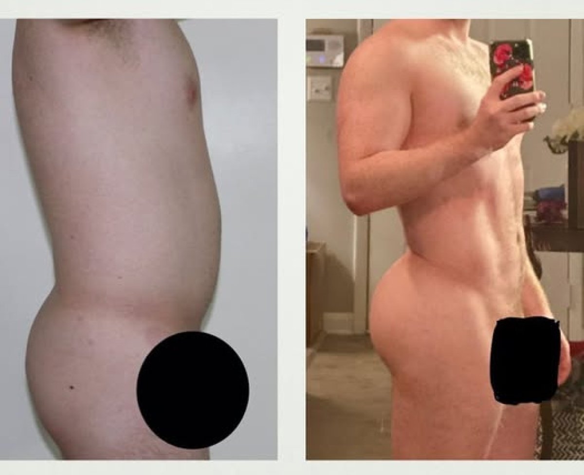 Before and after Brazilian Butt Lift results in male patient – enhanced gluteal contour