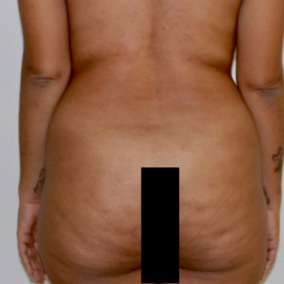 Resultado antes de Brazilian Butt Lift, contorno y volumen natural vistos desde atrás