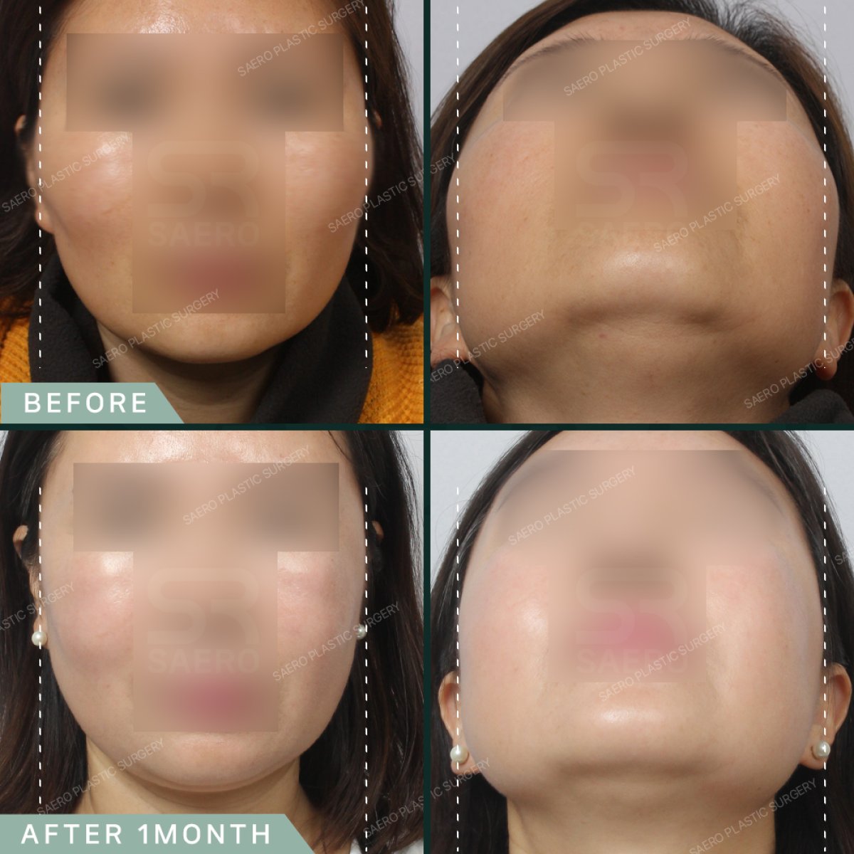 Avant et après réduction des pommettes chez SAERO Plastic Surgery, visage affiné