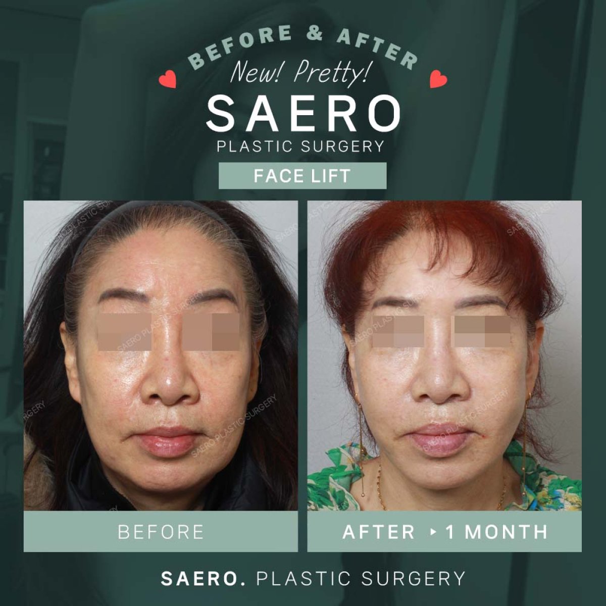 نتائج شد الوجه قبل وبعد في SAERO Plastic Surgery، تجديد واضح للوجه بعد شهر واحد