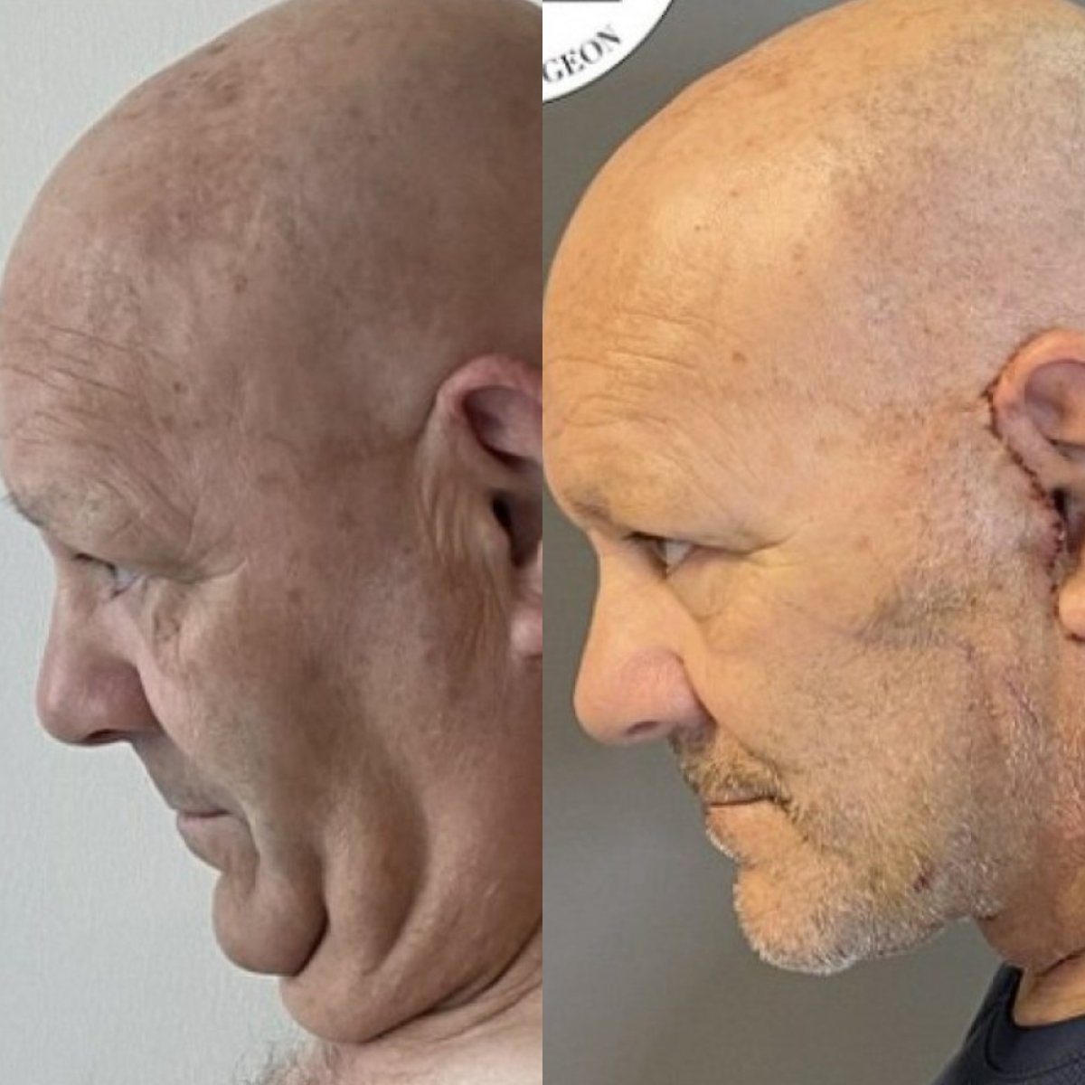Before and after deep plane facelift results in male patient – improved jawline definition