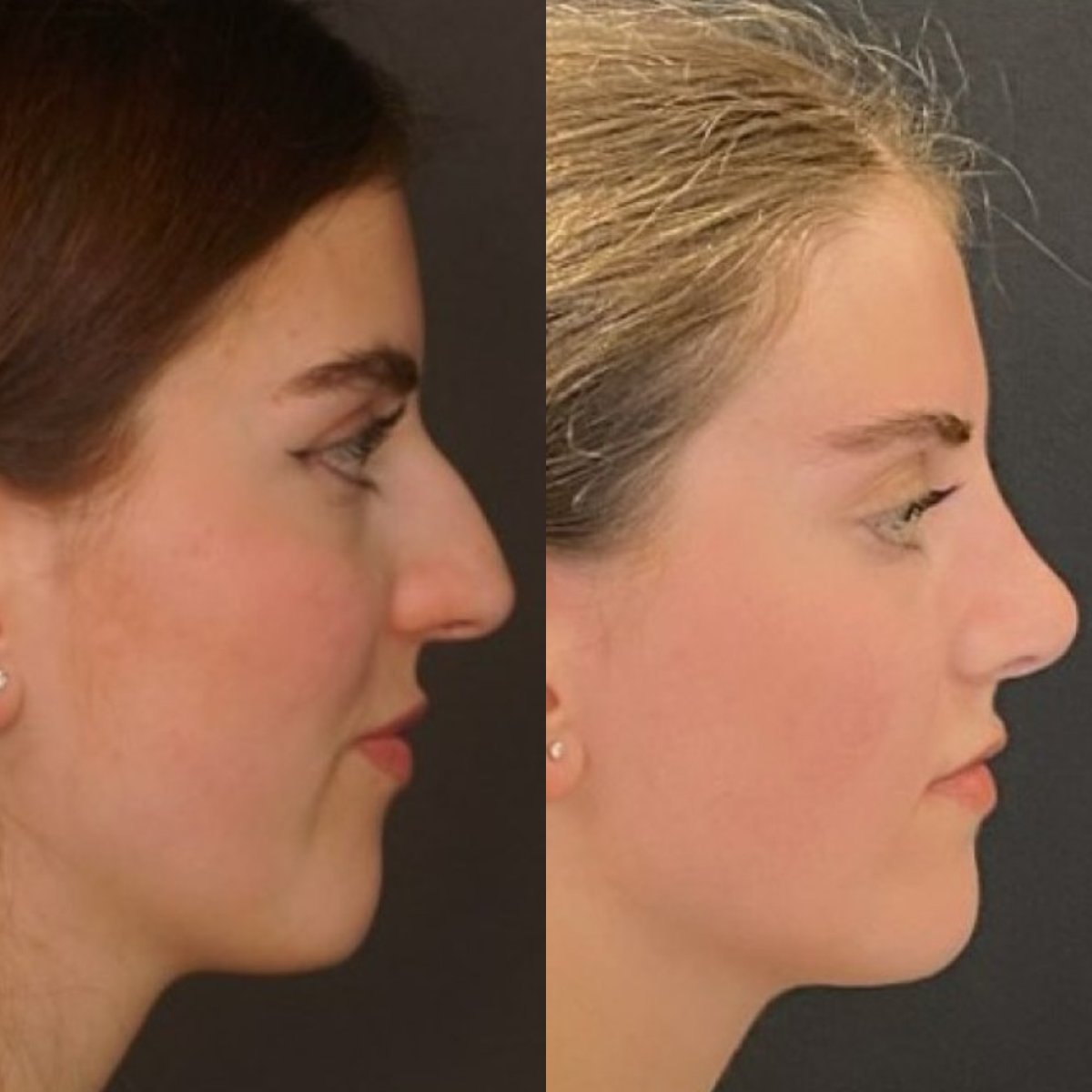 Résultats avant et après rhinoplastie, amélioration naturelle du profil du nez