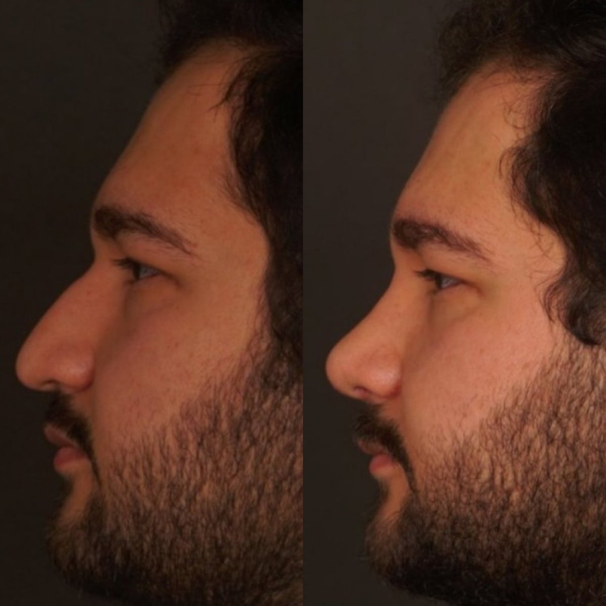 Résultats avant et après rhinoplastie chez un homme – forme et profil du nez améliorés