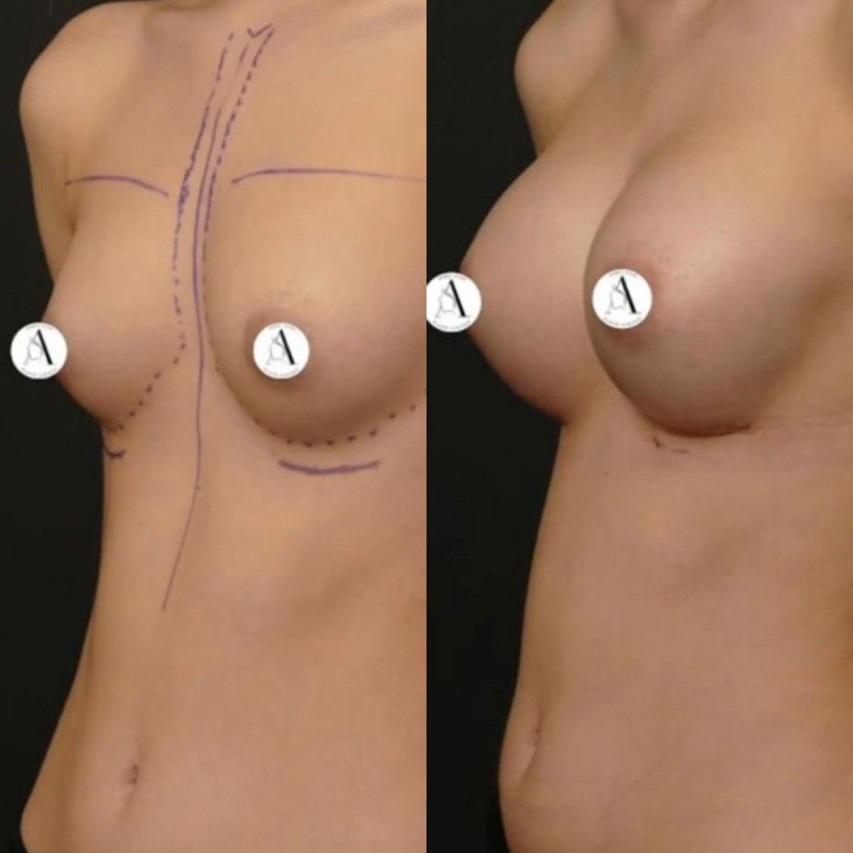 Before and after breast augmentation results – enhanced breast shape and volume