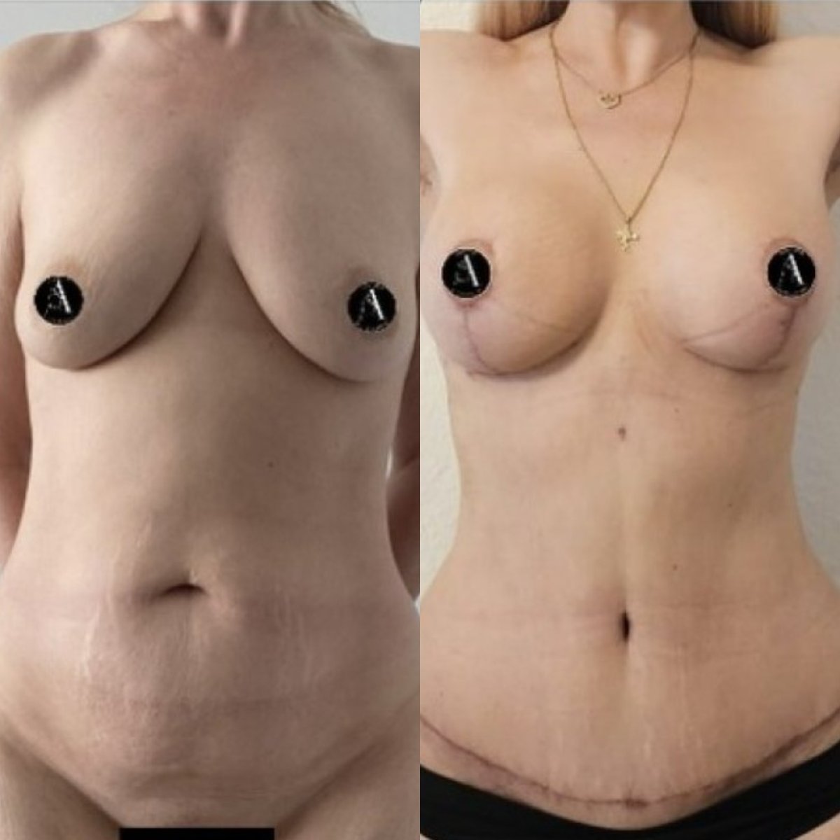 Resultados antes y después de mommy makeover – mejora en pecho y abdomen