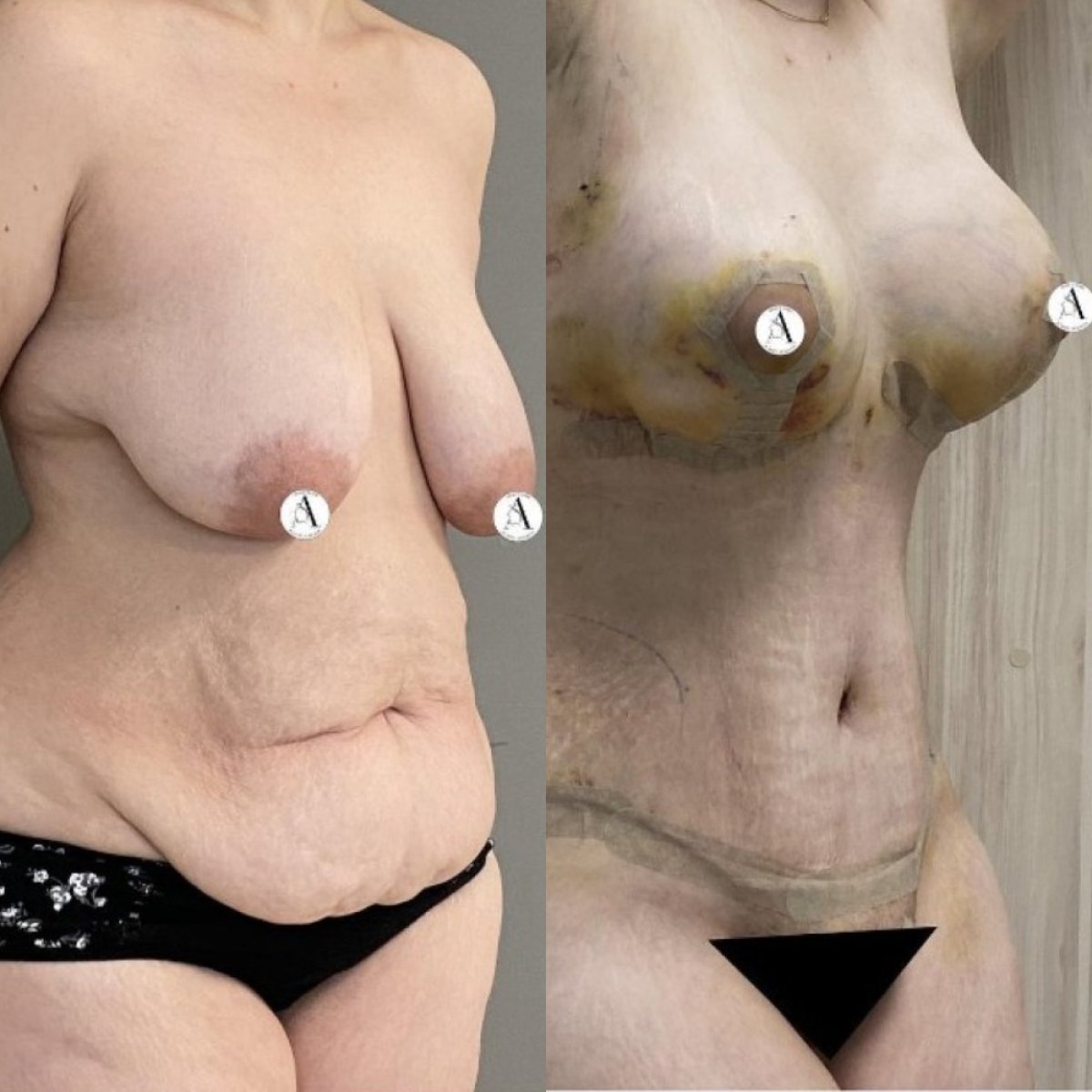 Resultados antes y después de mommy makeover: levantamiento de senos y abdominoplastia