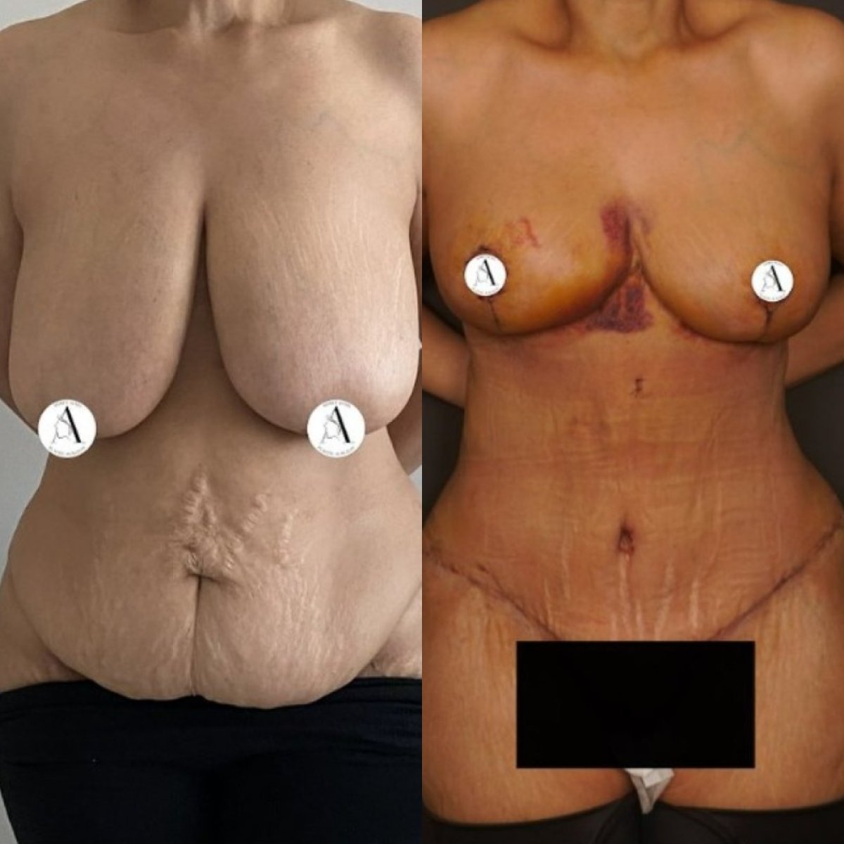 Mommy makeover before and after results – breast lift and tummy tuck visible improvement