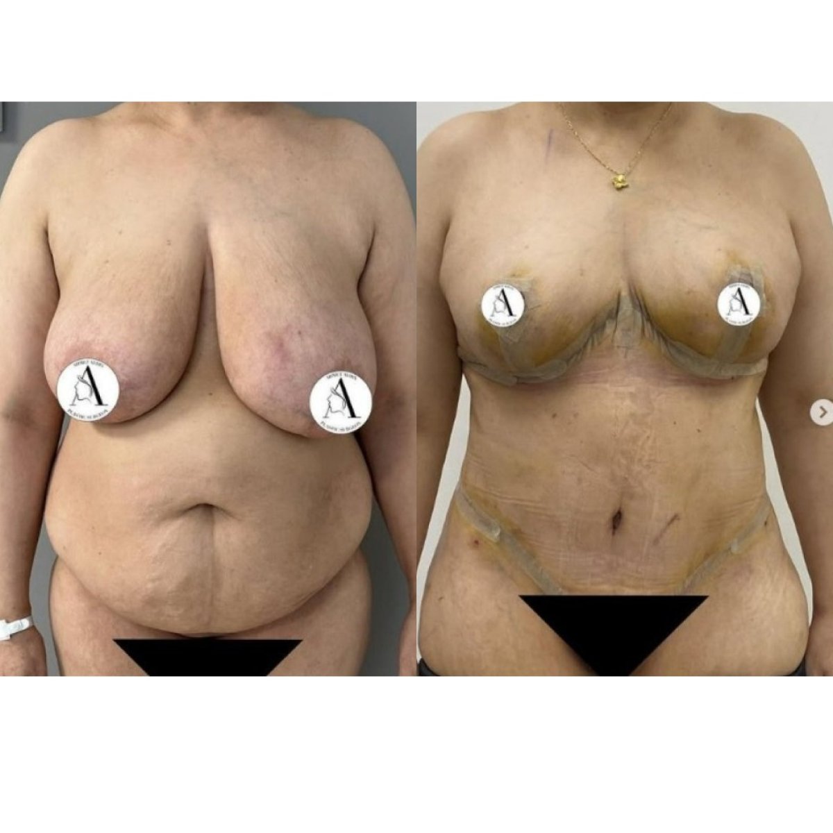 Before and after mommy makeover results – body contouring and breast lift transformation