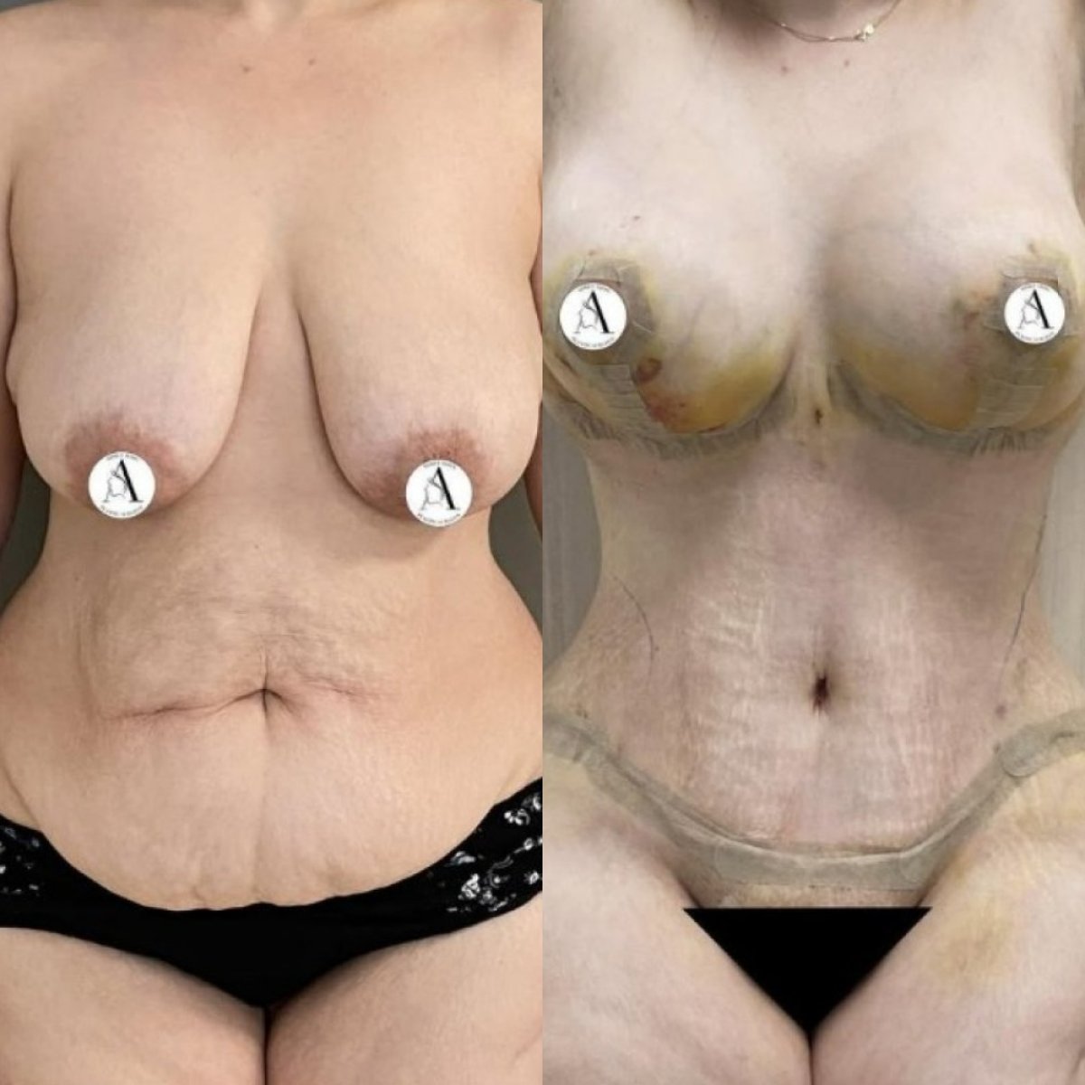 Resultados antes y después de mommy makeover: mejora visible en senos y abdomen