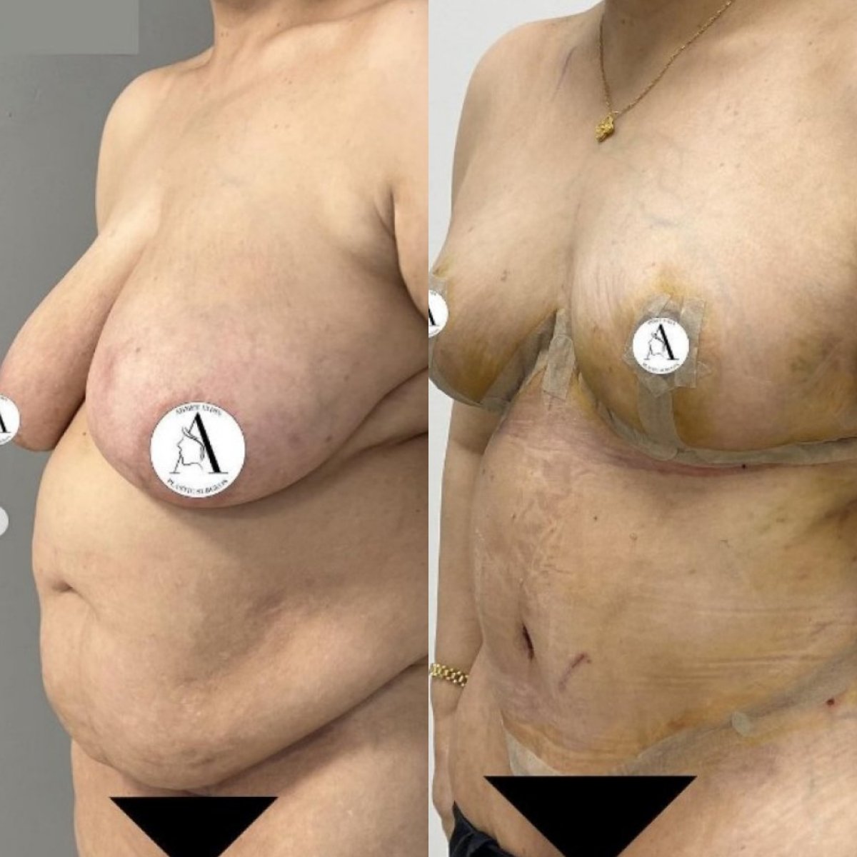 Resultados antes y después de mommy makeover: levantamiento de senos y abdominoplastia