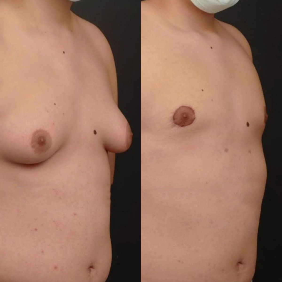 Before and after gynecomastia surgery results – male chest contour improvement