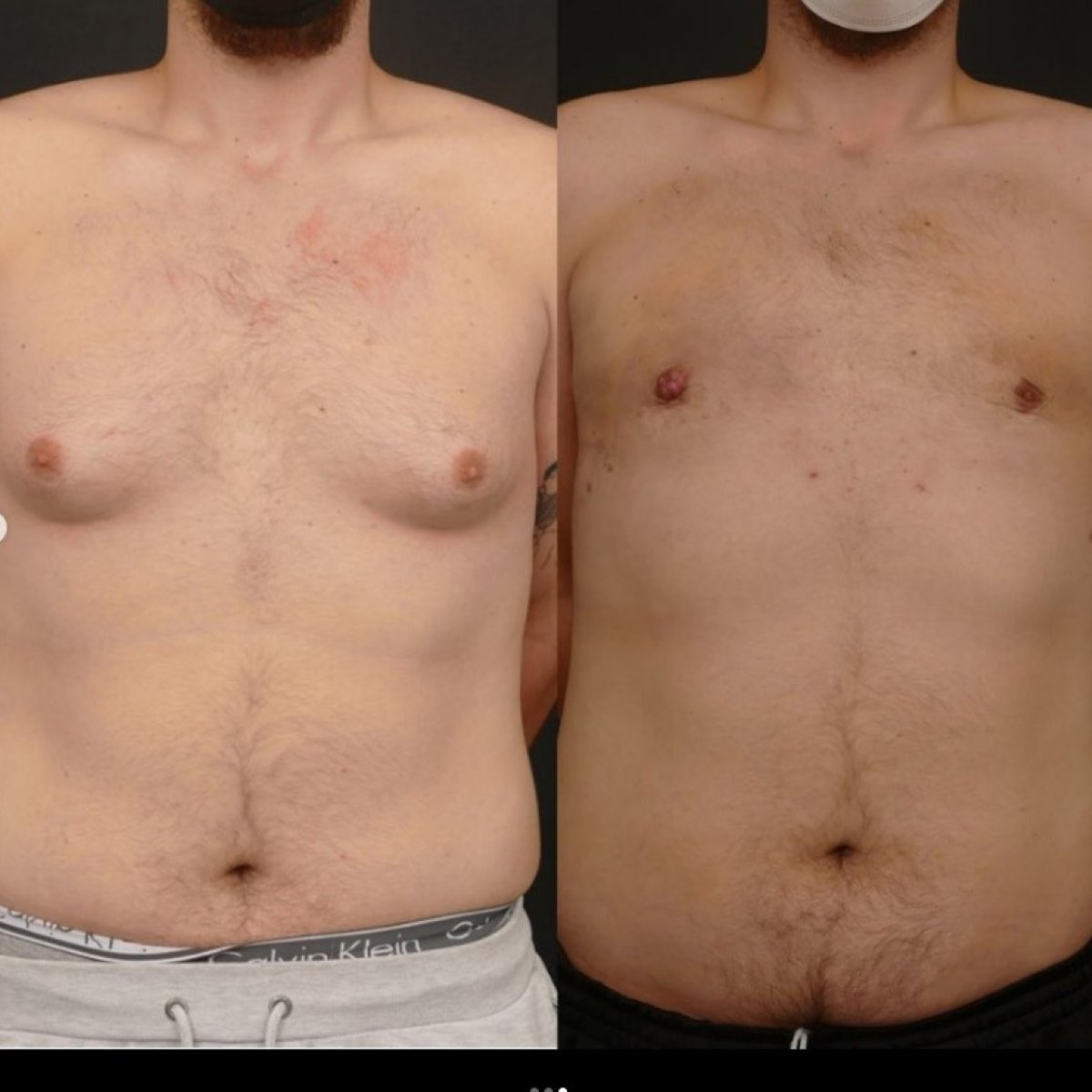 Before and after gynecomastia surgery results – flatter male chest contour improvement