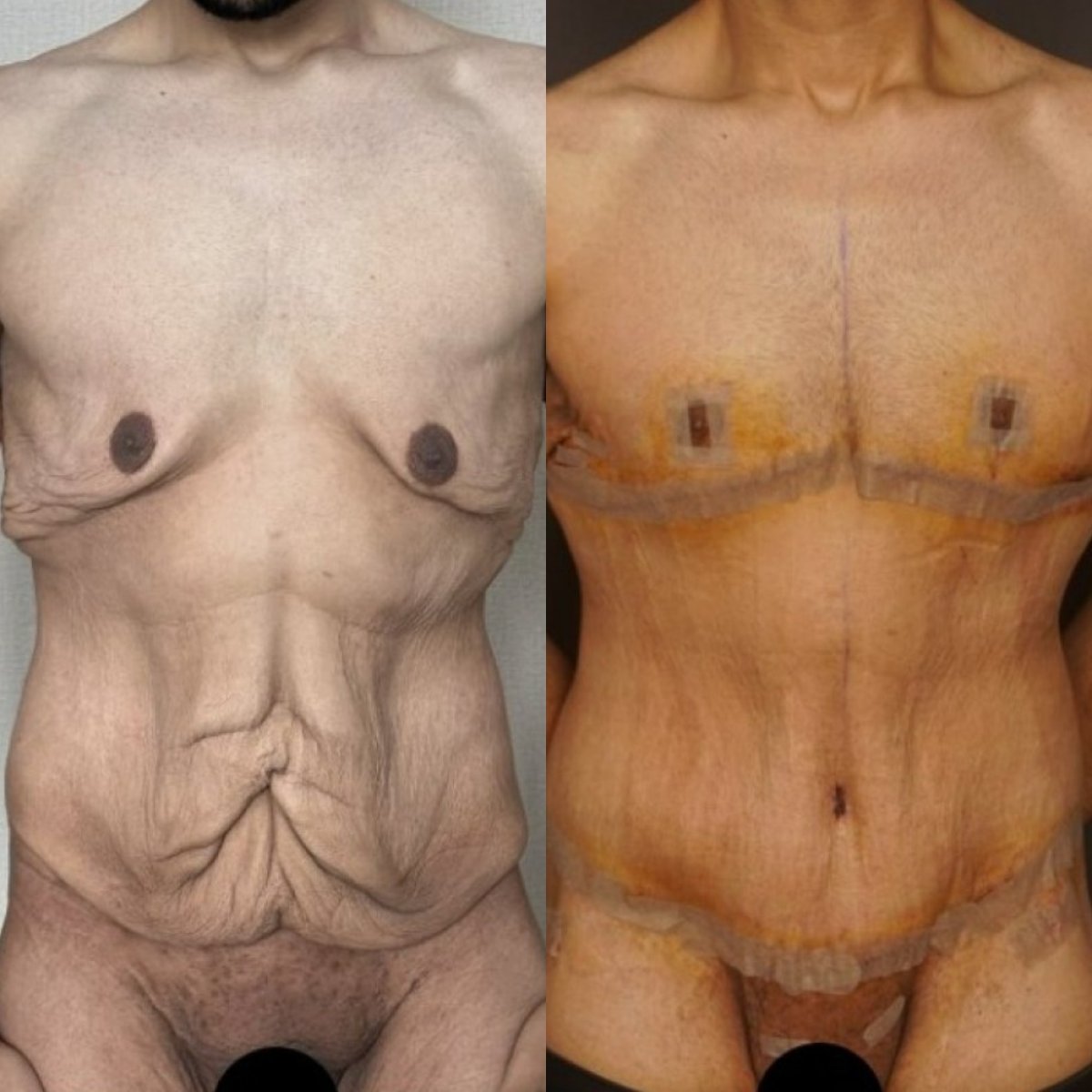نتائج قبل وبعد جراحة التجميل بعد السمنة – إزالة الجلد الزائد وتحديد الجسم