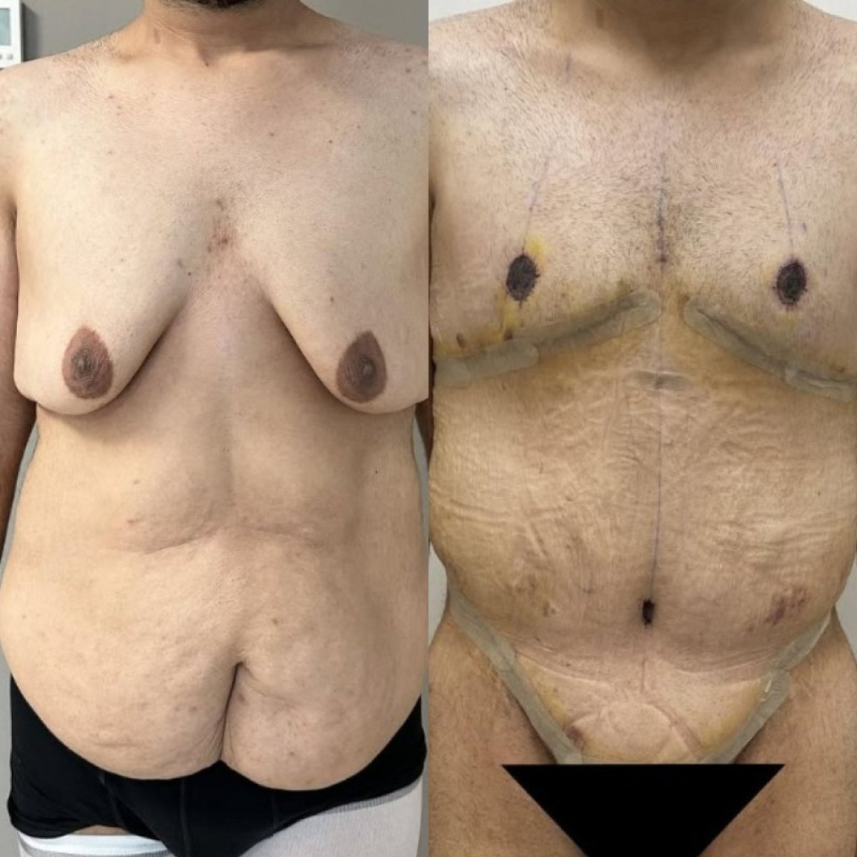 نتائج قبل وبعد جراحة التجميل بعد السمنة – تحسين شكل الصدر والبطن