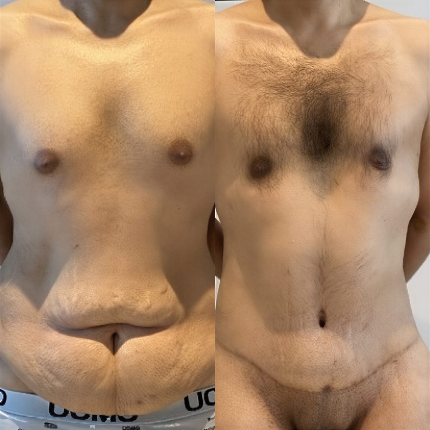 Resultados de abdominoplastia en hombre antes y después – contorno abdominal mejorado