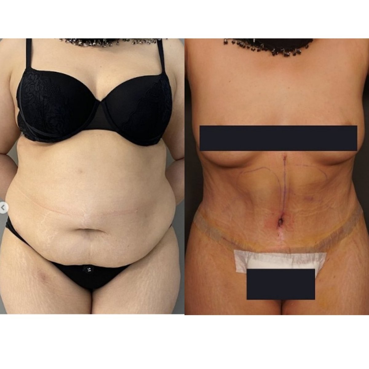 Resultados de abdominoplastia antes y después: mejora visible del contorno abdominal