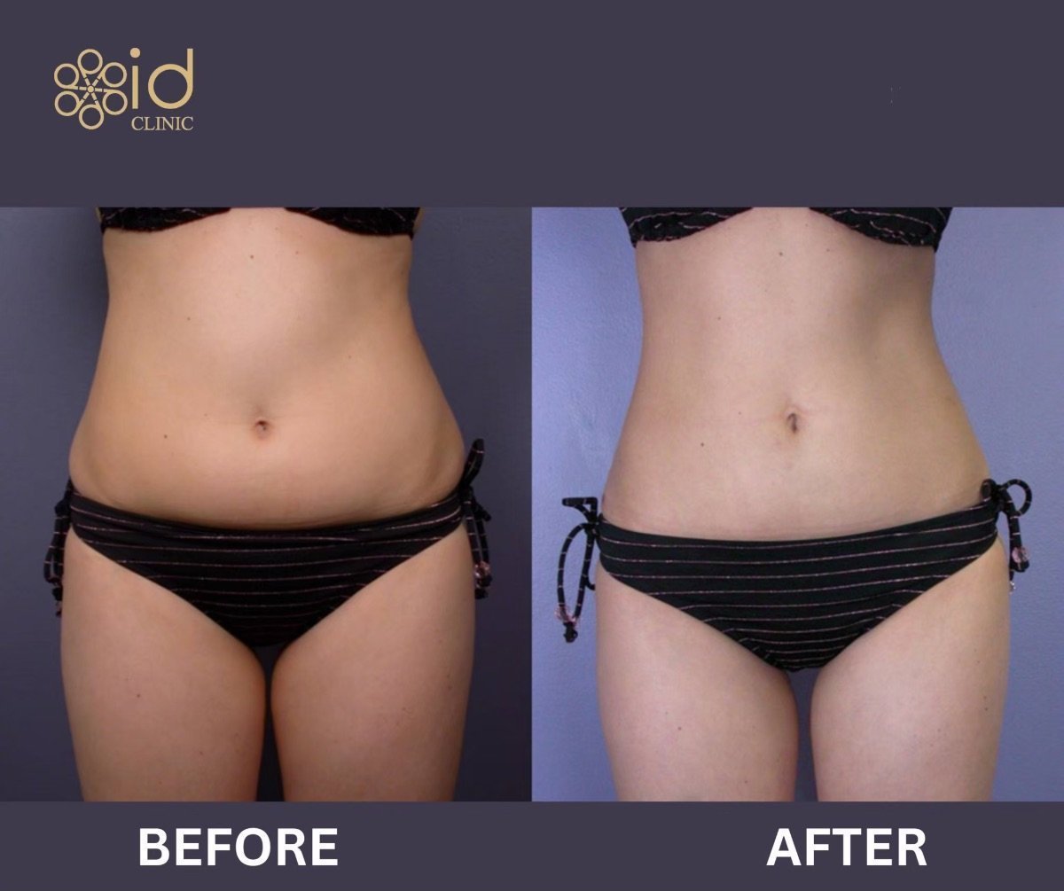 Before and after Vaser liposuction results at ID Clinic Bangkok, slimmer waist and abdomen