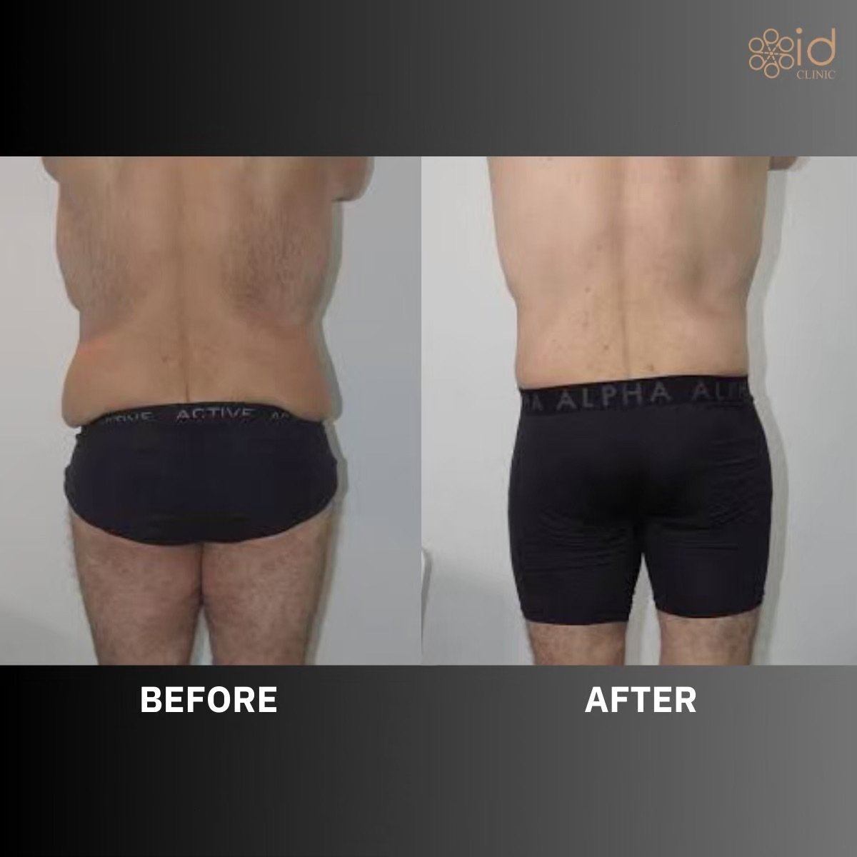 Before and after Vaser liposuction results at ID Clinic Bangkok, improved lower back contour