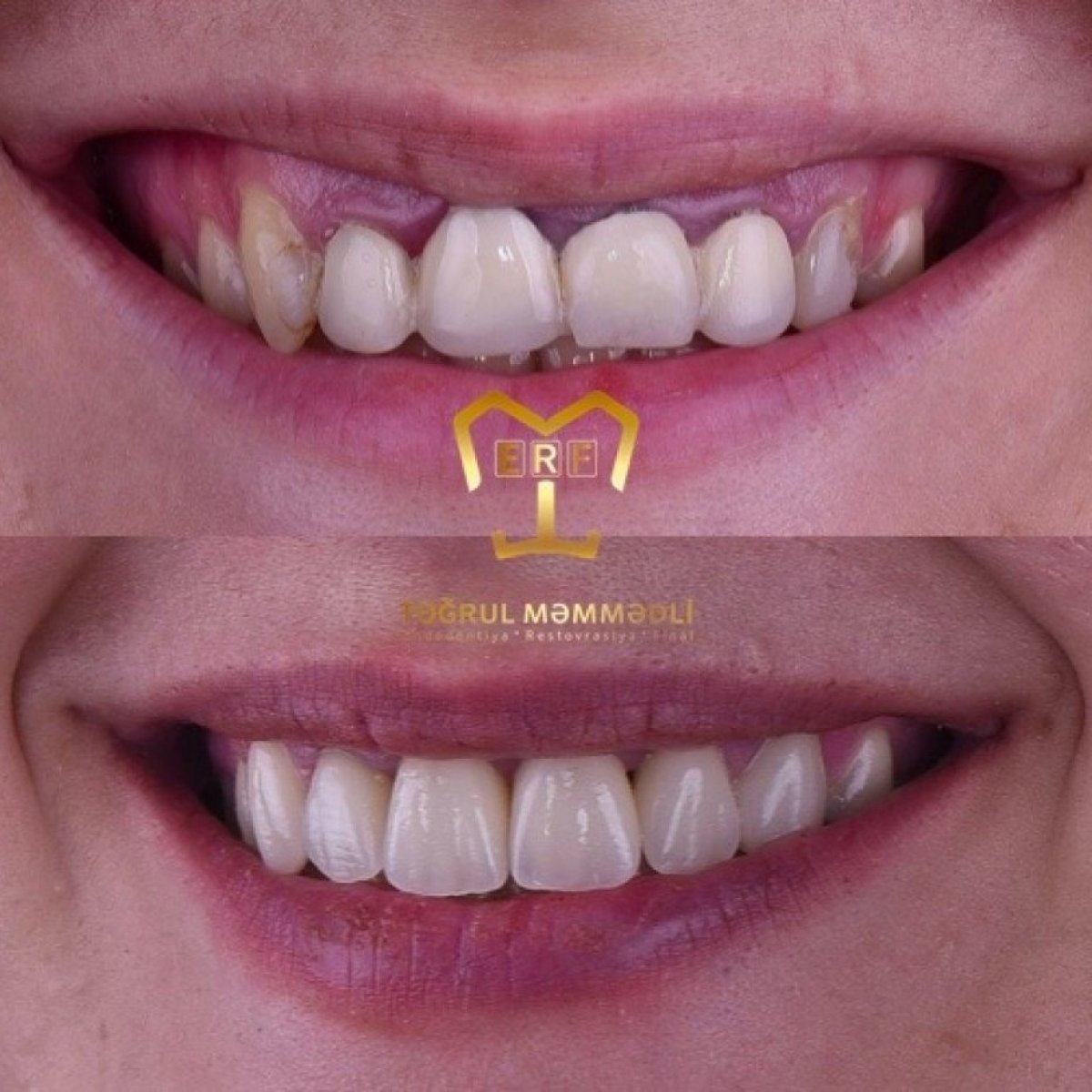 قبل وبعد الفينير في Dentaland Premium Luxury Clinic & Academy، نتيجة تجميل الابتسامة