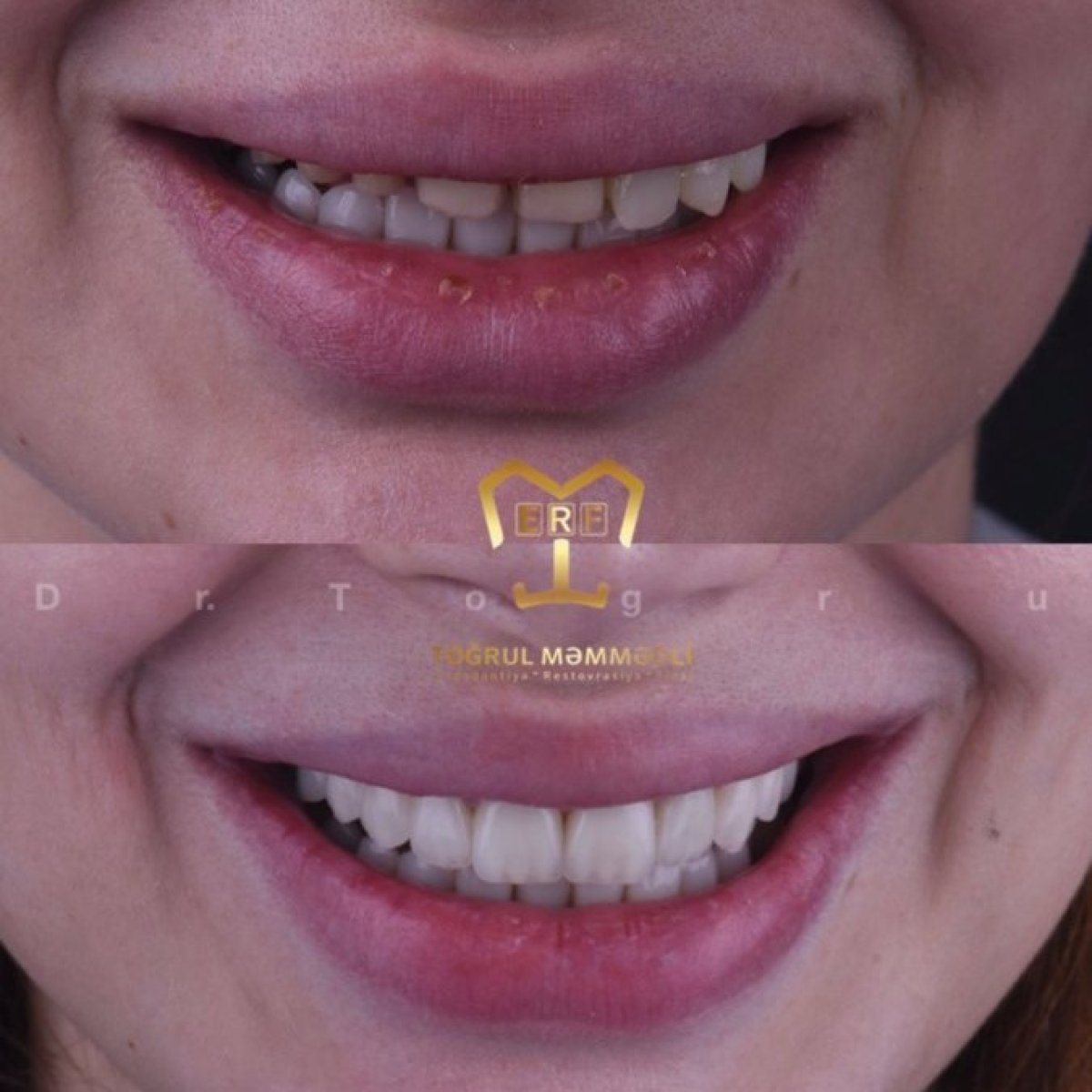 Résultat avant et après facettes à Dentaland Premium Luxury Clinic & Academy, sourire transformé