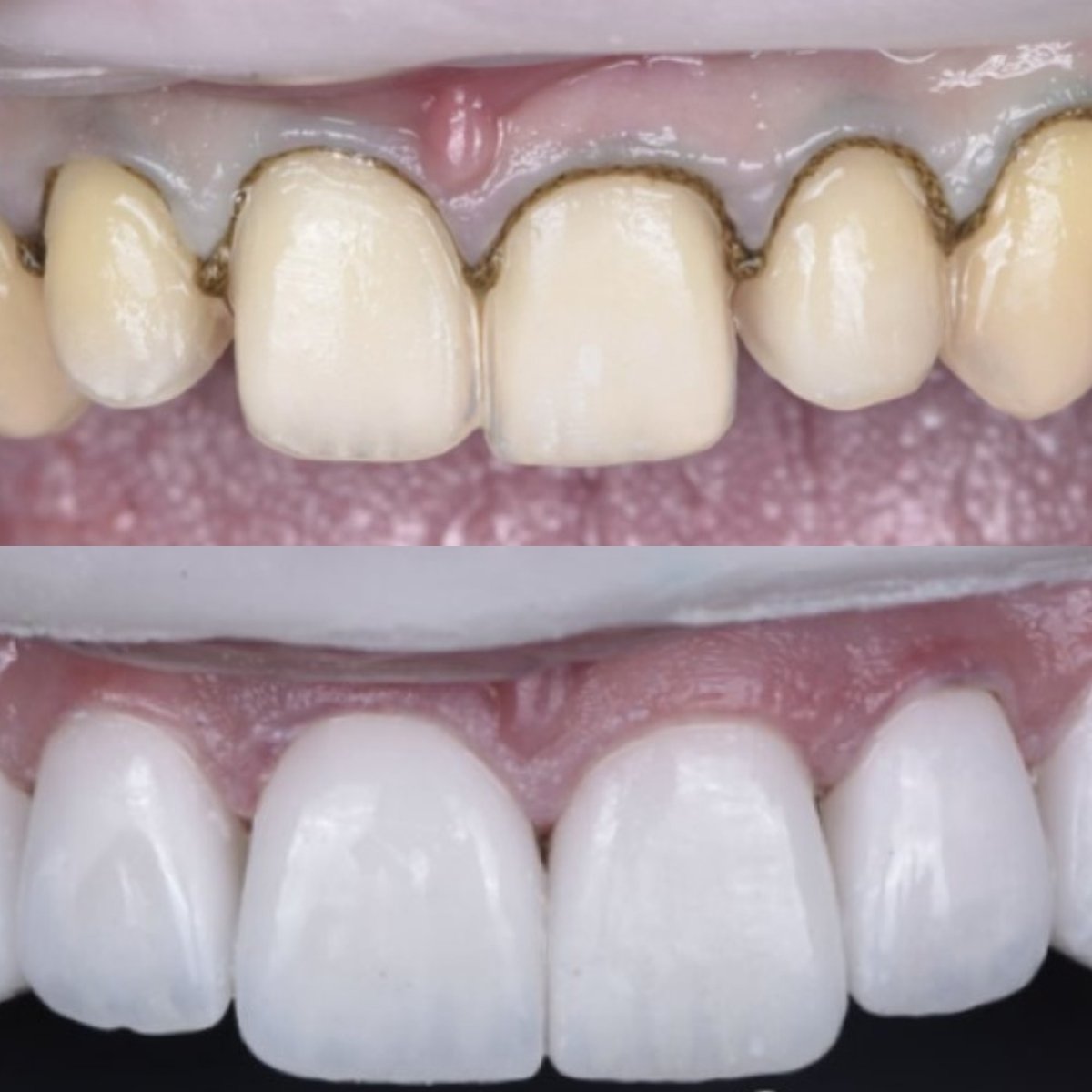 Résultat avant et après facettes dentaires à Dentaland Premium Luxury Clinic & Academy, sourire transformé
