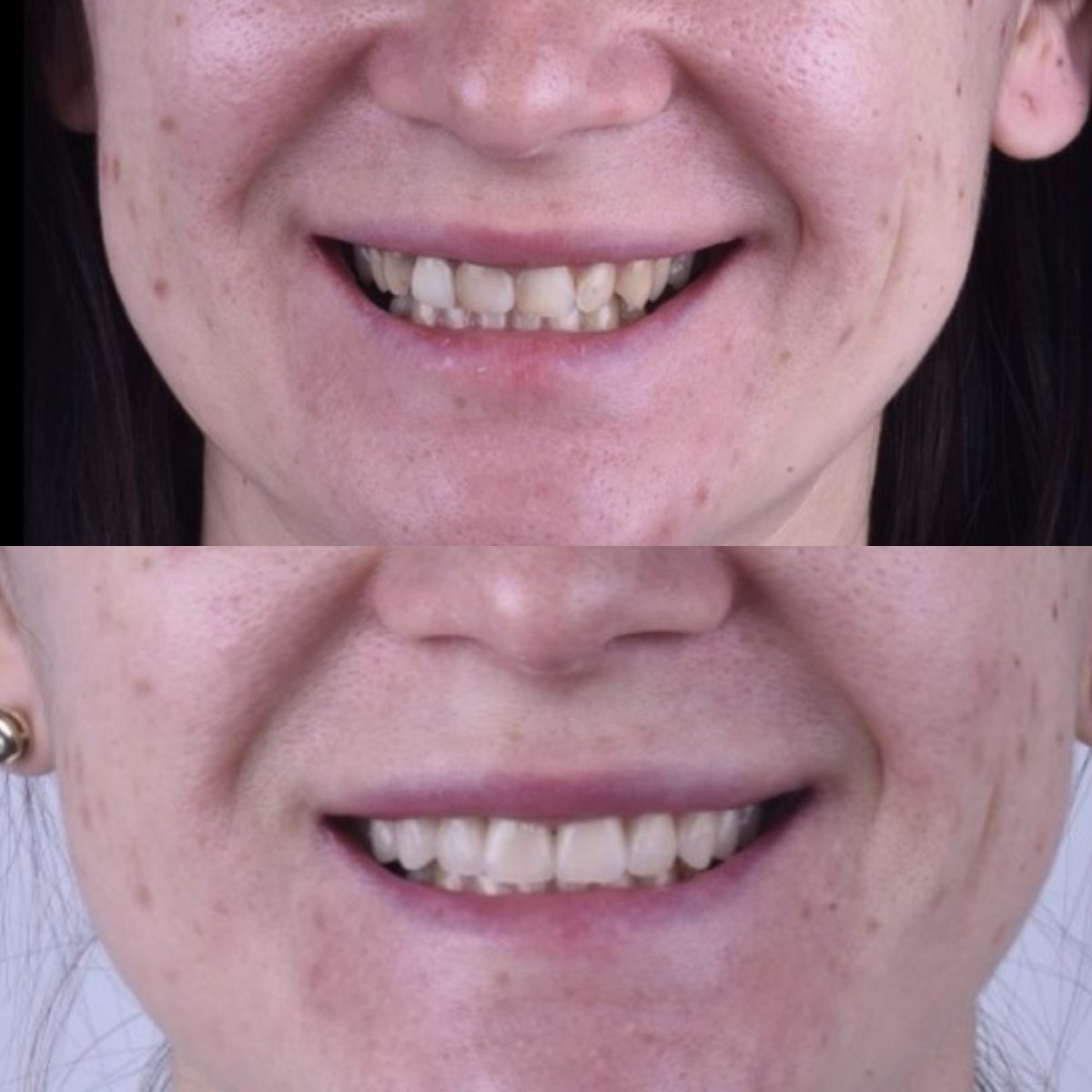 Resultado antes y después de carillas en Dentaland Premium Luxury Clinic & Academy, sonrisa