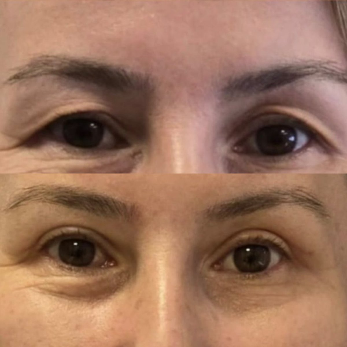 Before and after blepharoplasty results at Turan Turan Health Group, eyelid correction surgery