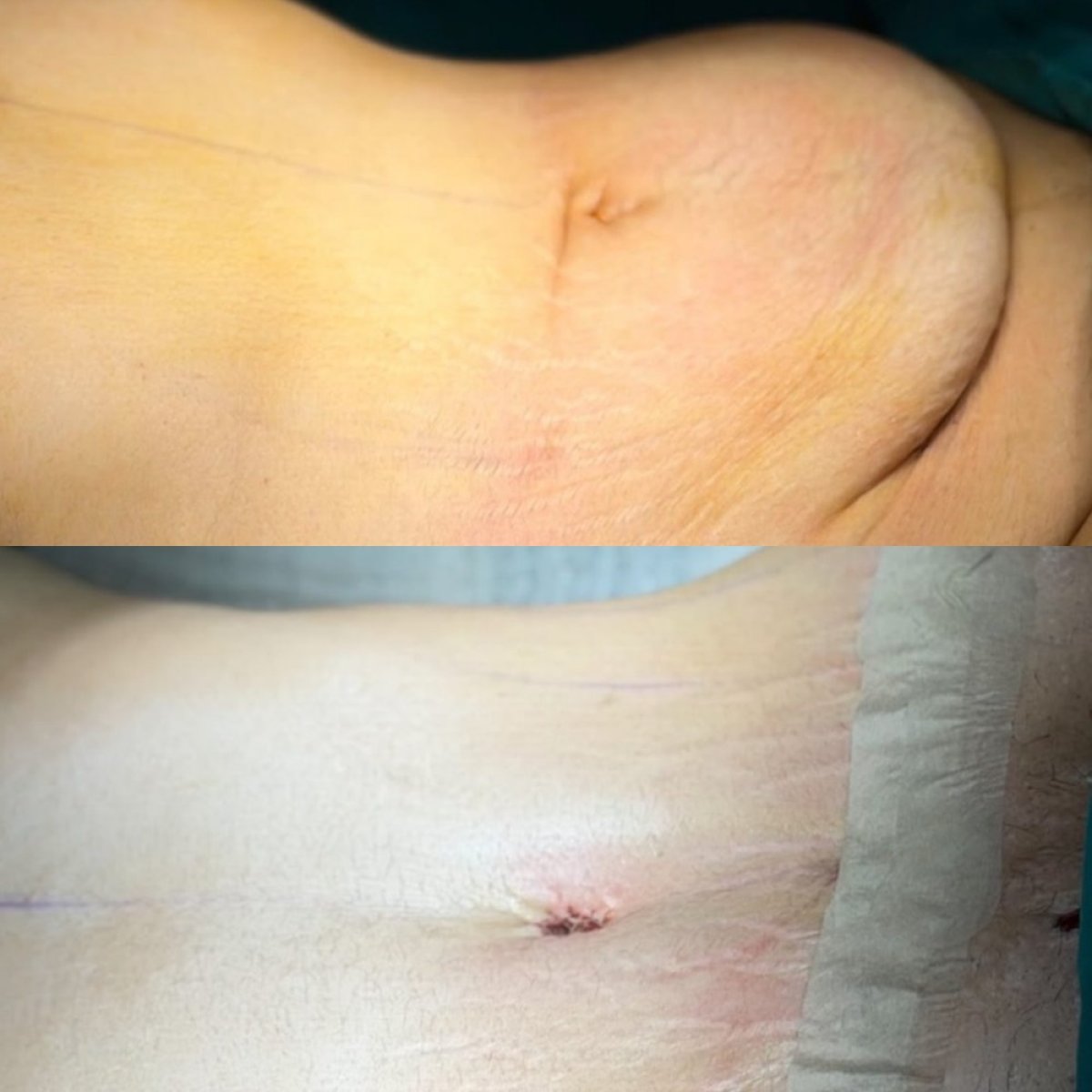 Resultados de abdominoplastia antes y después en Turan Turan Health Group, mejor contorno abdominal