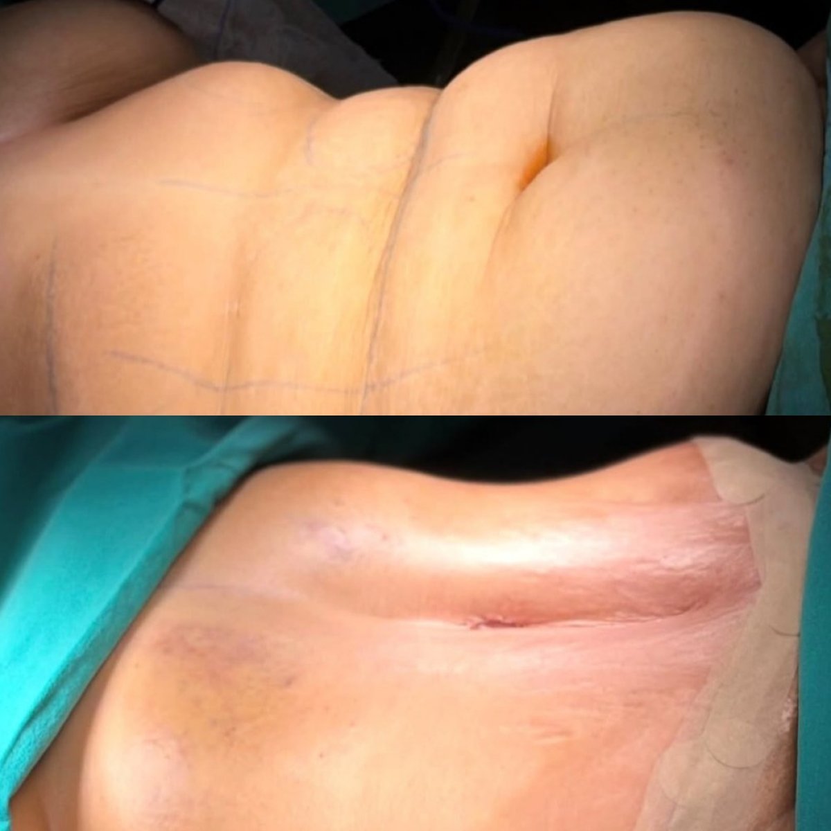 Resultados de abdominoplastia antes y después en Turan Turan Health Group, contorno mejorado