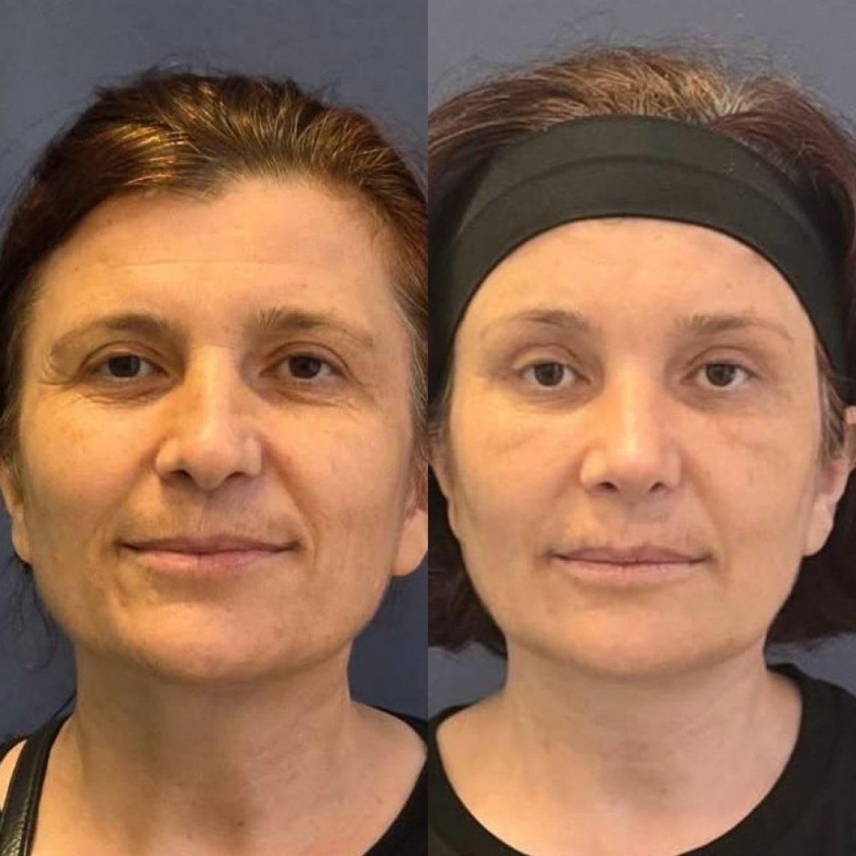 Forehead lift before and after results at Turan Turan Health Group, visible rejuvenation