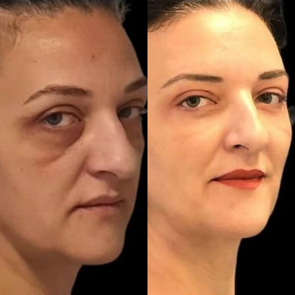 Forehead lift before and after results at Turan Turan Health Group, smoother youthful appearance