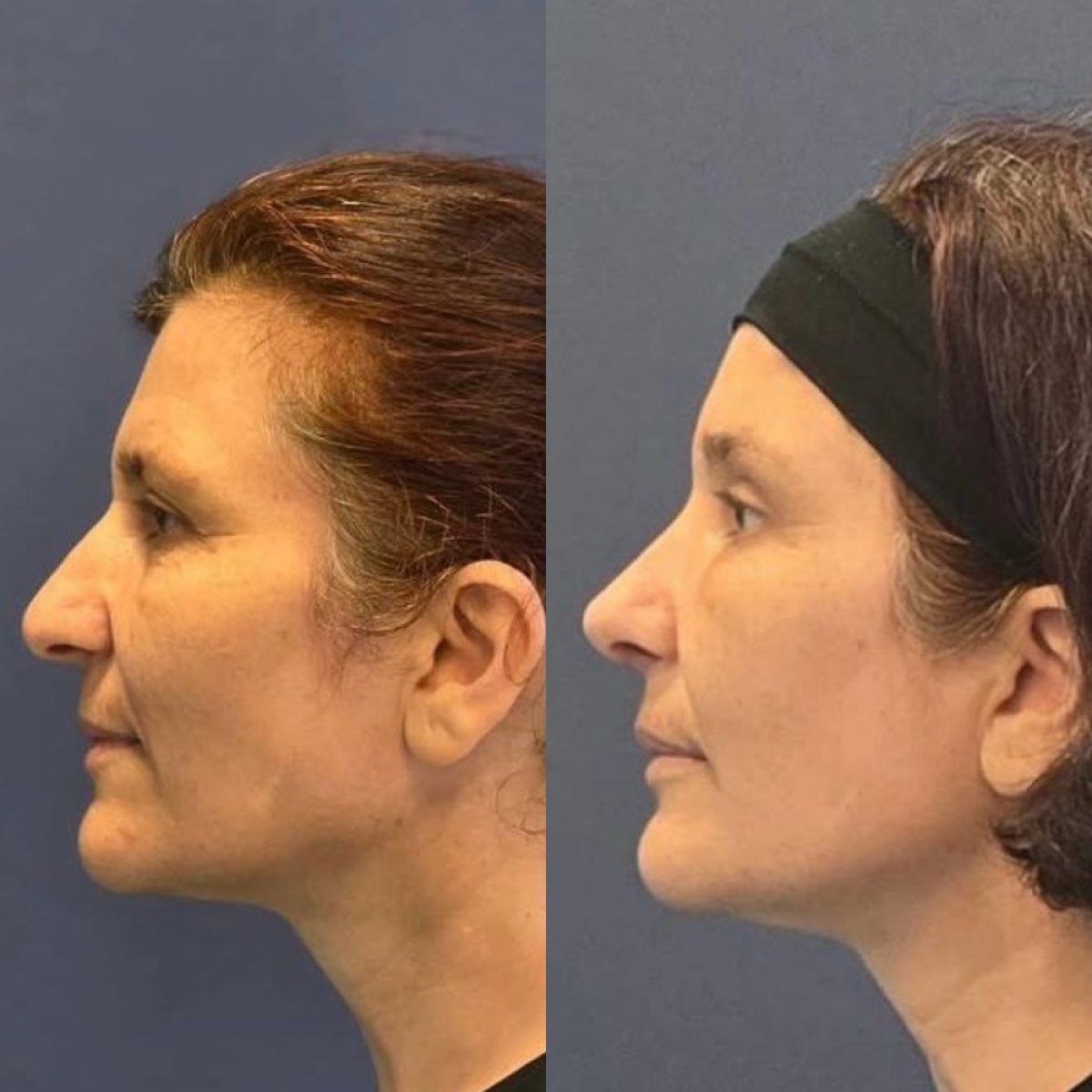 Forehead lift before and after results at Turan Turan Health Group, visible brow elevation