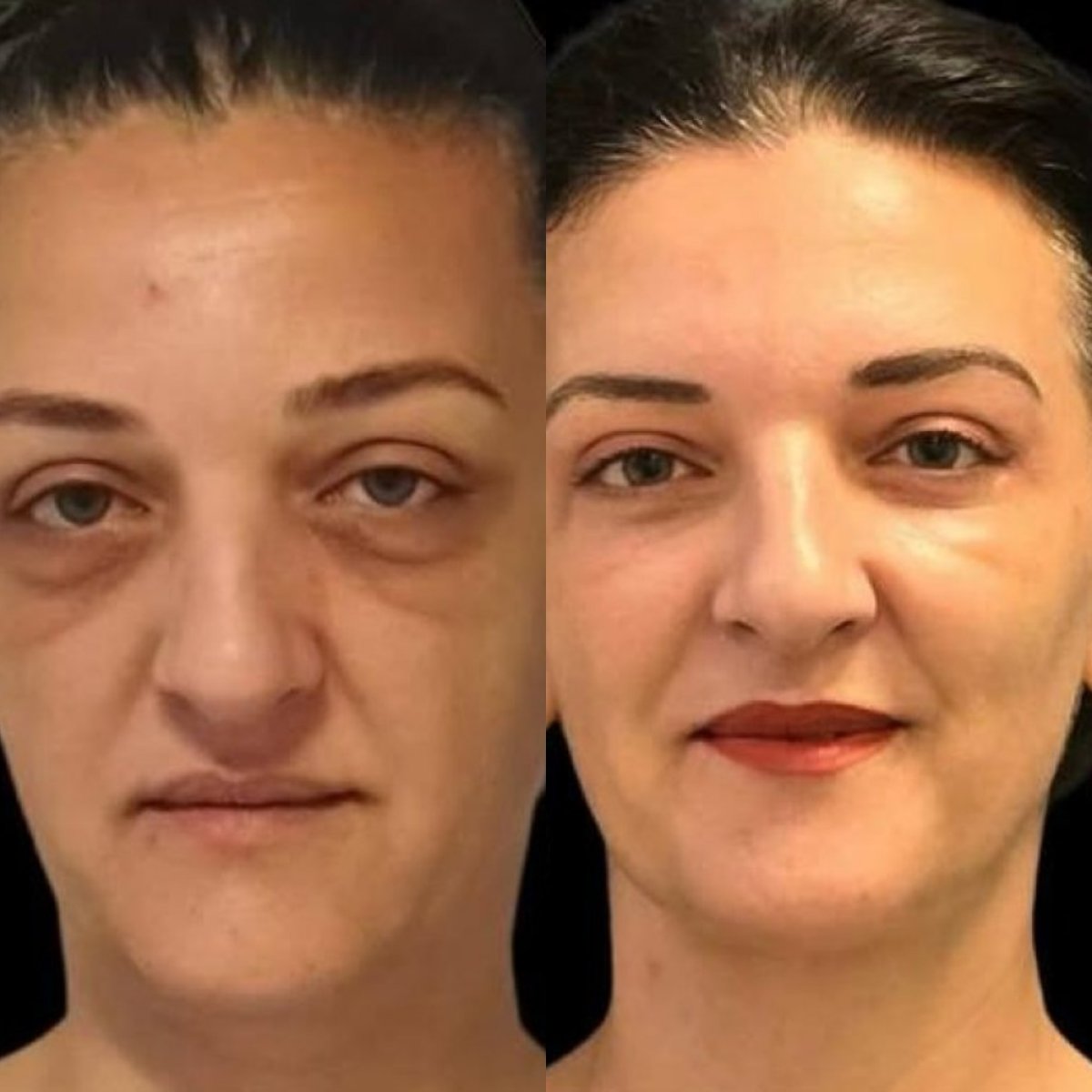 Forehead lift before and after results at Turan Turan Health Group, visible rejuvenation