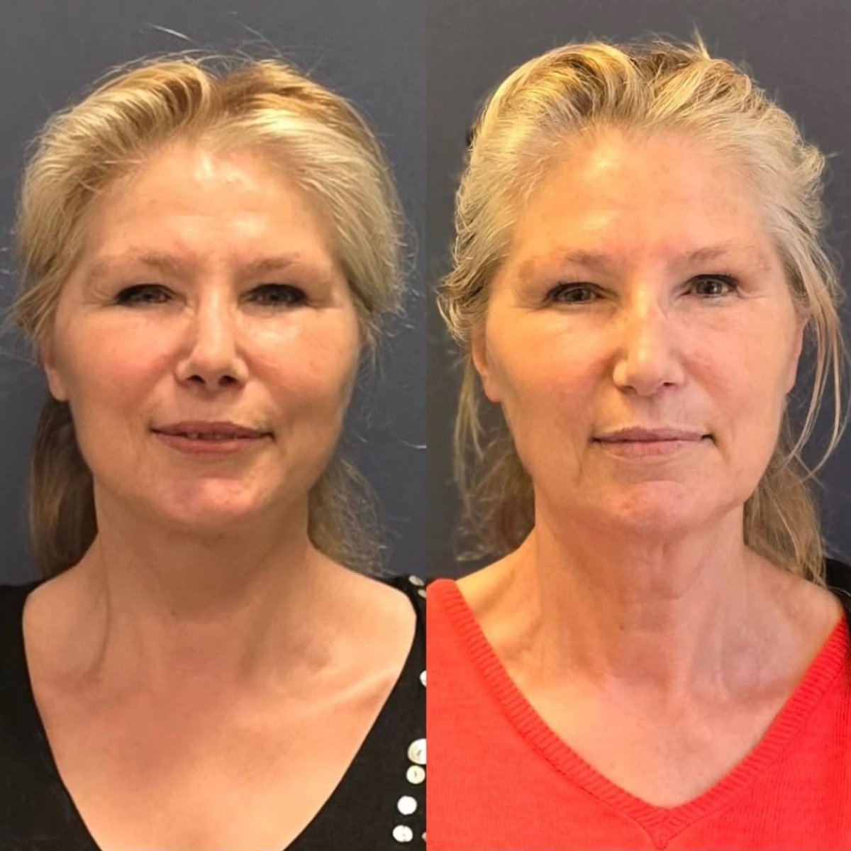 Forehead lift before and after results at Turan Turan Health Group, visible rejuvenation