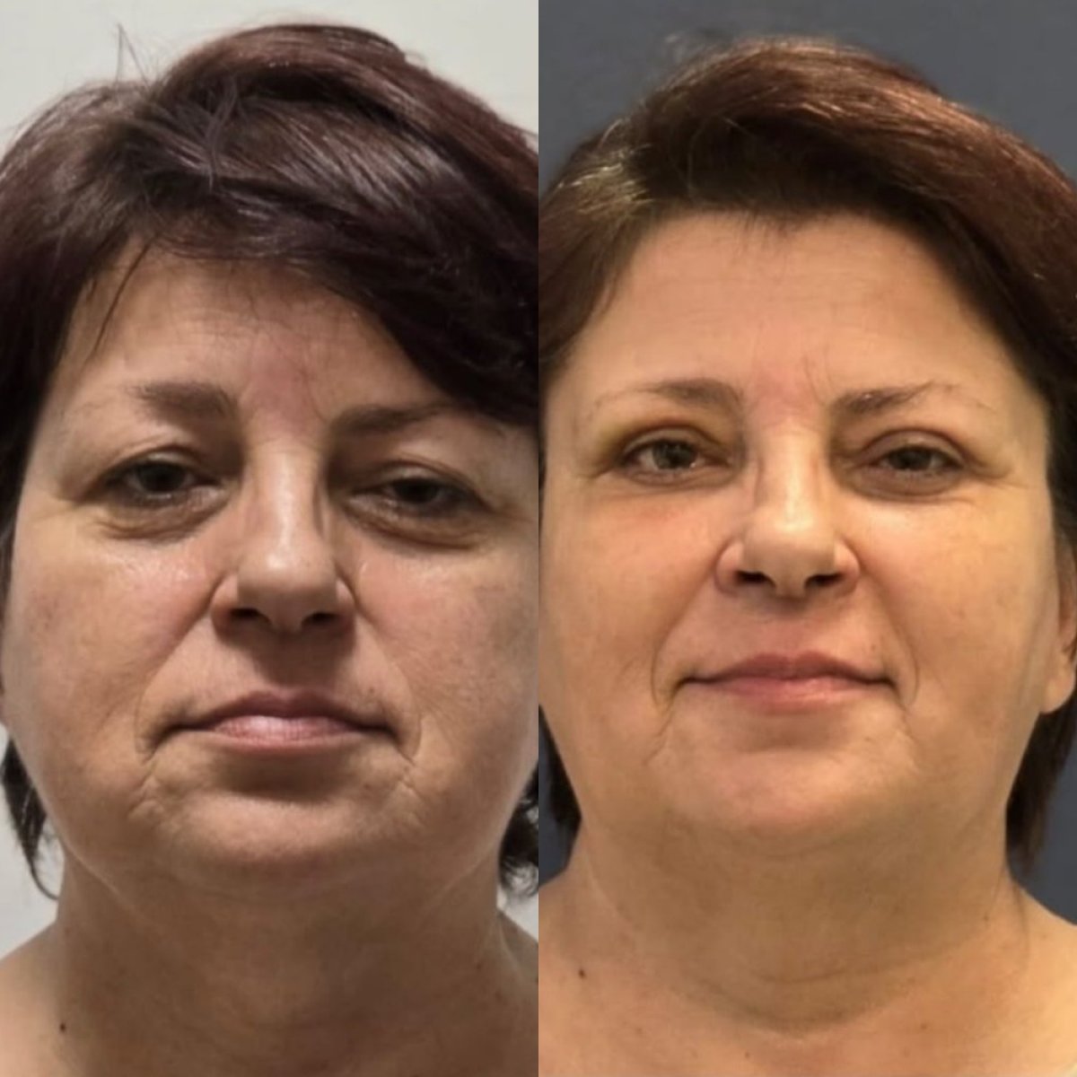 Forehead lift before and after results at Turan Turan Health Group, visible facial rejuvenation