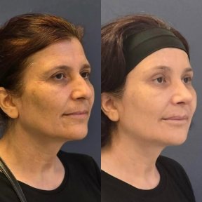 Forehead Lift Surgery with Transfers - photo 5