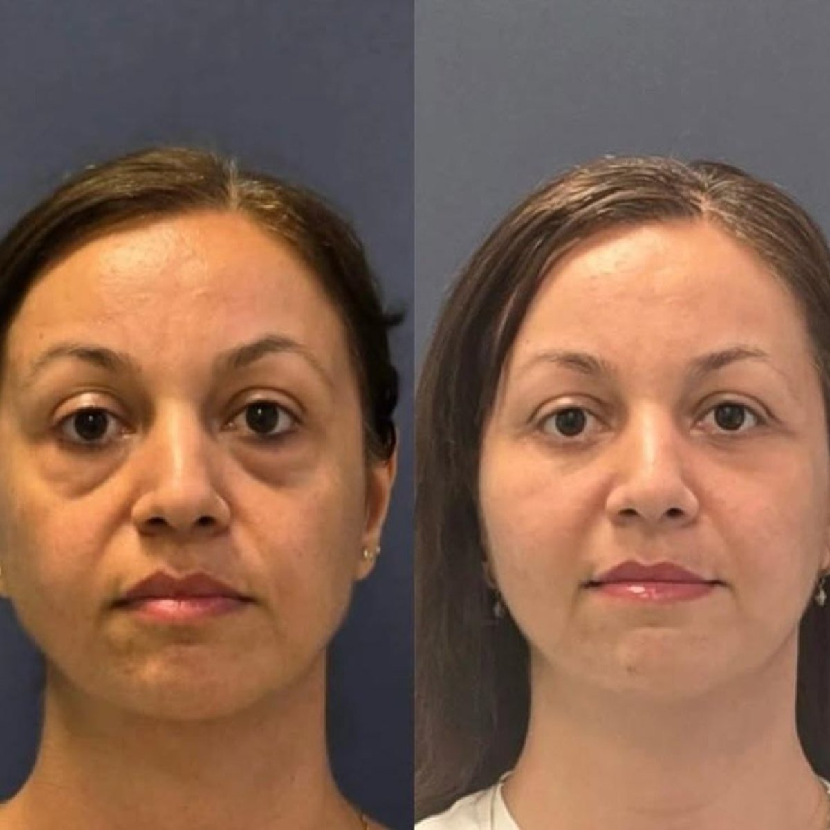 Forehead lift before and after results at Turan Turan Health Group, visible rejuvenation