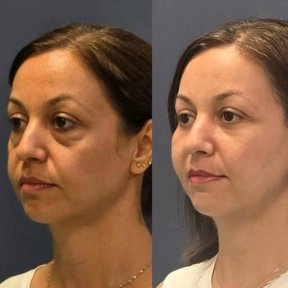 Forehead Lift Surgery with Transfers - photo 4