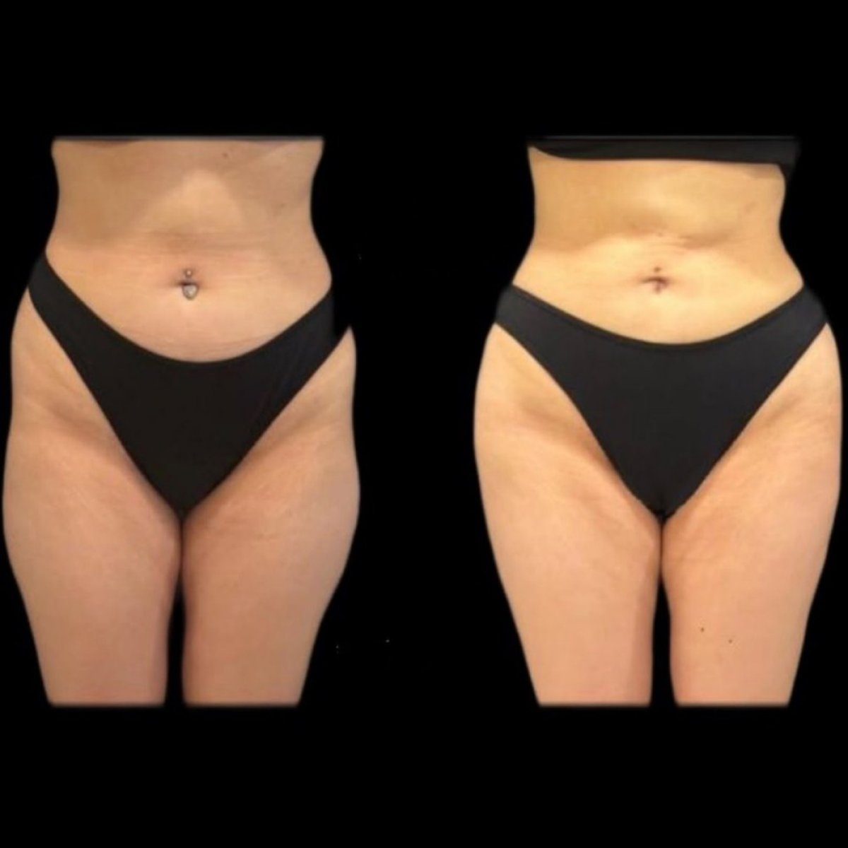 Before and after thigh lift results at Turan Turan Health Group, improved thigh contour