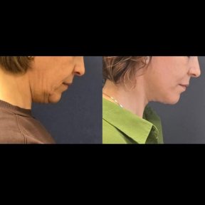 Face Lift Surgery (Facelift/Rhytidectomy) - photo 6