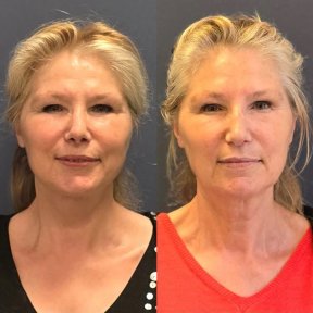 Face Lift Surgery (Facelift/Rhytidectomy) - photo 4