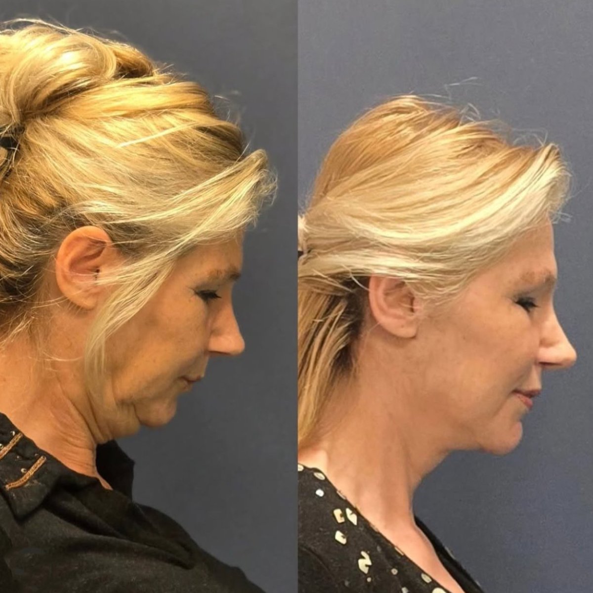Résultats avant/après liposuccion du cou chez Turan Turan Health Group, contour amélioré