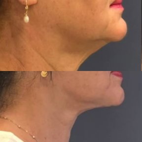 Neck Liposuction - Submental Liposuction (Double Chin Liposuction) - photo 5